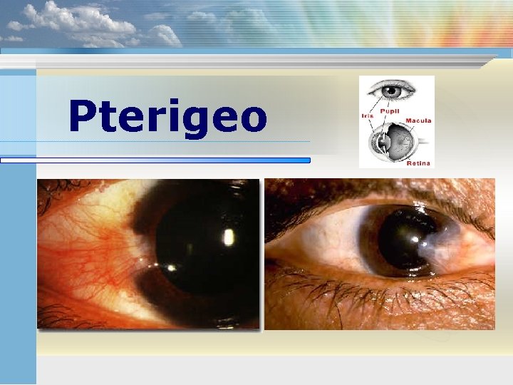 Pterigeo 
