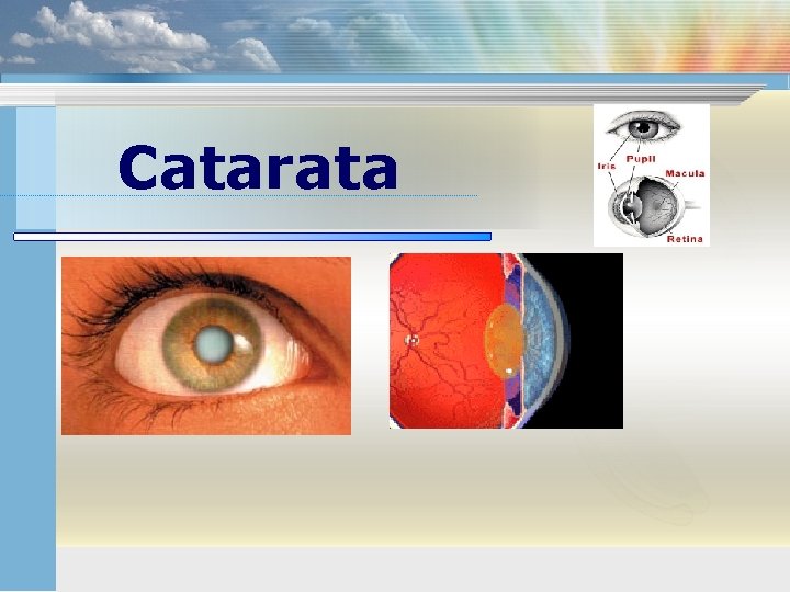 Catarata 