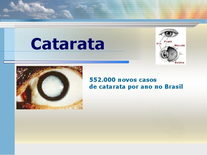 Catarata 552. 000 novos casos de catarata por ano no Brasil 