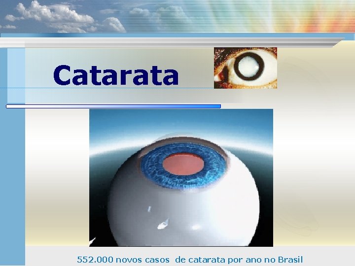 Catarata 552. 000 novos casos de catarata por ano no Brasil 