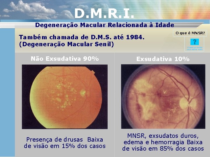 D. M. R. I. Degeneração Macular Relacionada à Idade Também chamada de D. M.