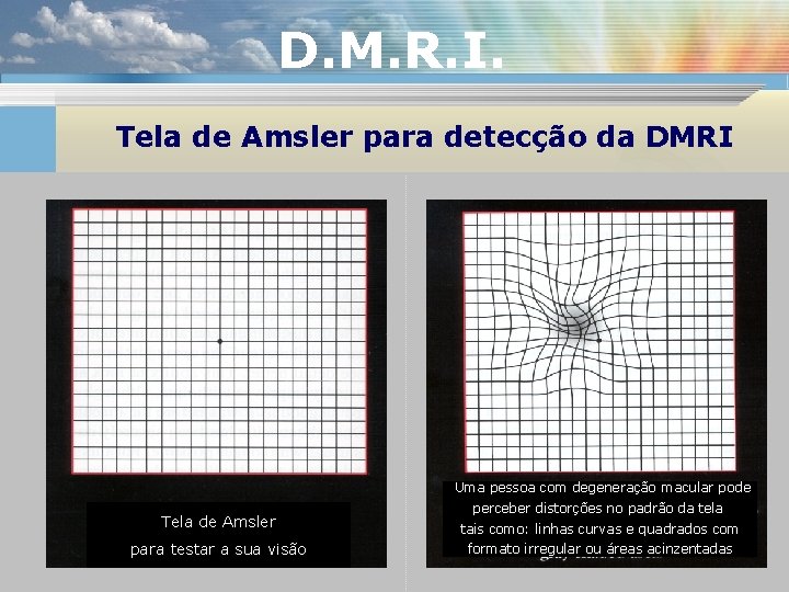 D. M. R. I. Tela de Amsler para detecção da DMRI Uma pessoa com
