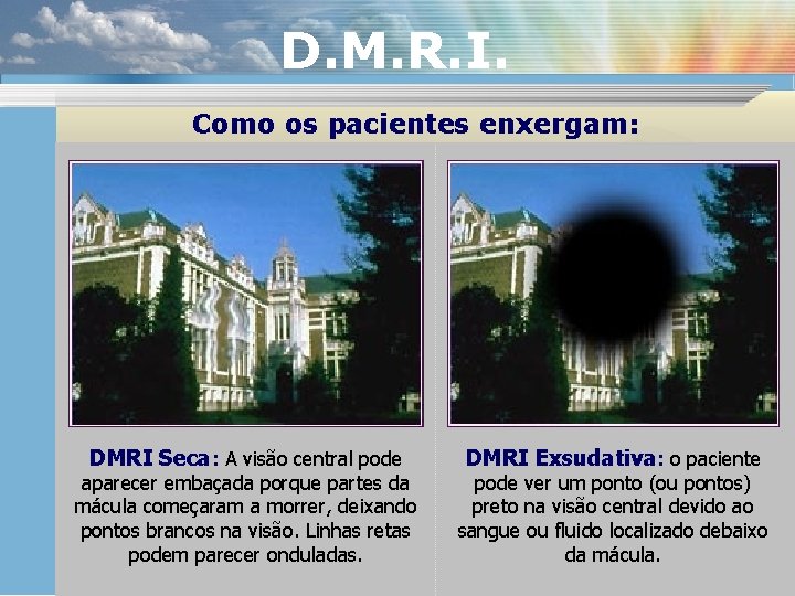 D. M. R. I. Como os pacientes enxergam: DMRI Seca: A visão central pode