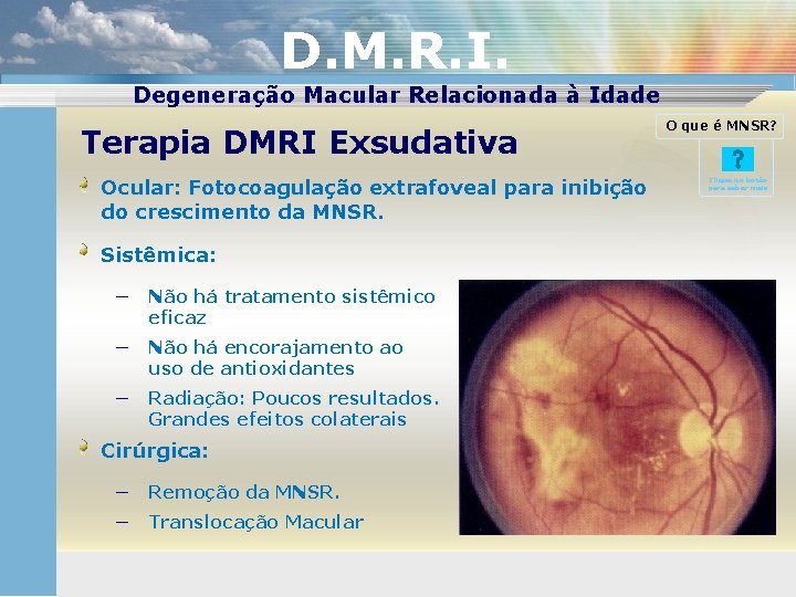 D. M. R. I. Degeneração Macular Relacionada à Idade Terapia DMRI Exsudativa Ocular: Fotocoagulação