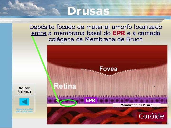 Drusas Depósito focado de material amorfo localizado entre a membrana basal do EPR e