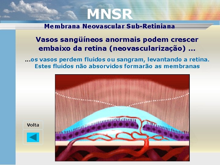MNSR Membrana Neovascular Sub-Retiniana Vasos sangüíneos anormais podem crescer embaixo da retina (neovascularização). .