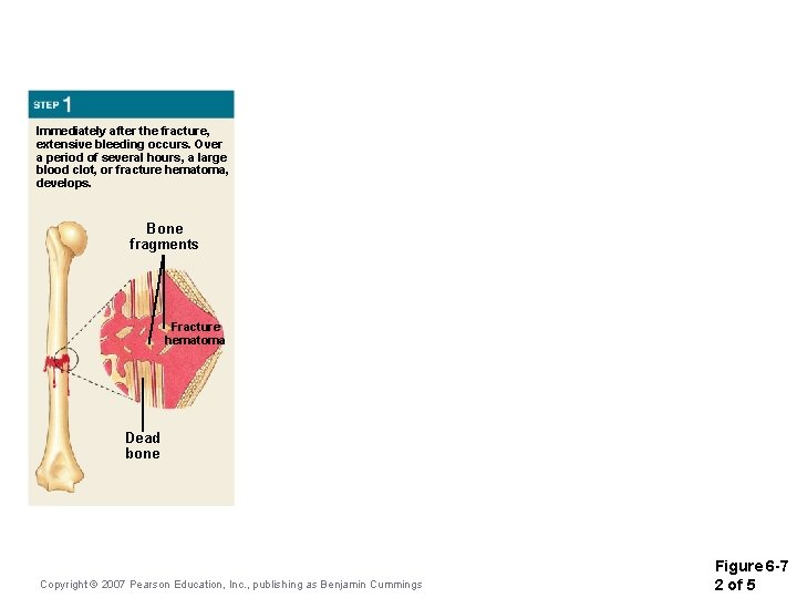 Immediately after the fracture, extensive bleeding occurs. Over a period of several hours, a