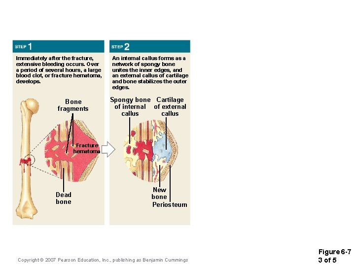 Immediately after the fracture, extensive bleeding occurs. Over a period of several hours, a