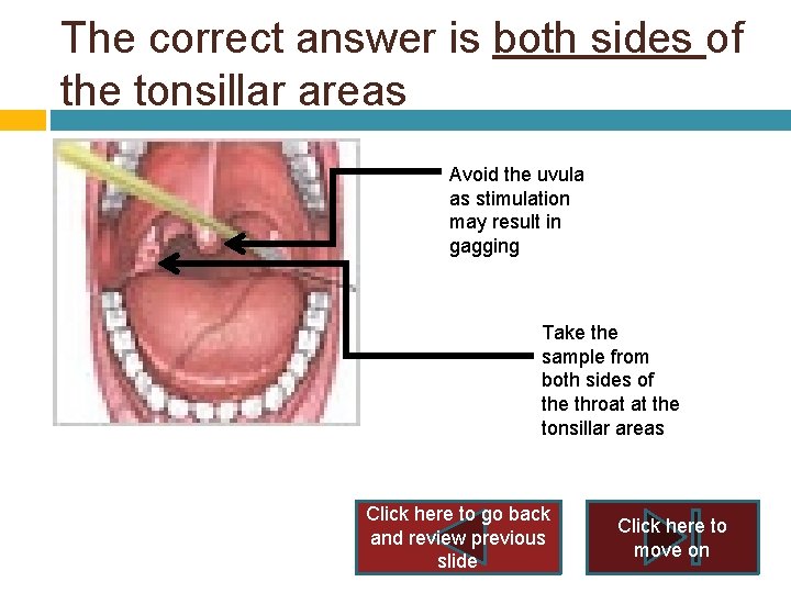 The correct answer is both sides of the tonsillar areas Avoid the uvula as The correct answer is both sides of the tonsillar areas Avoid the uvula as