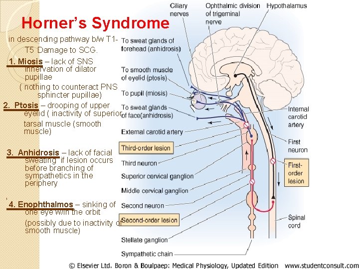 Horner’s Syndrome in descending pathway b/w T 1 T 5 Damage to SCG. 1.