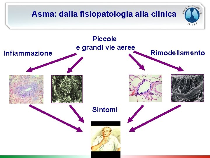Asma: dalla fisiopatologia alla clinica Infiammazione Piccole e grandi vie aeree Sintomi Rimodellamento 