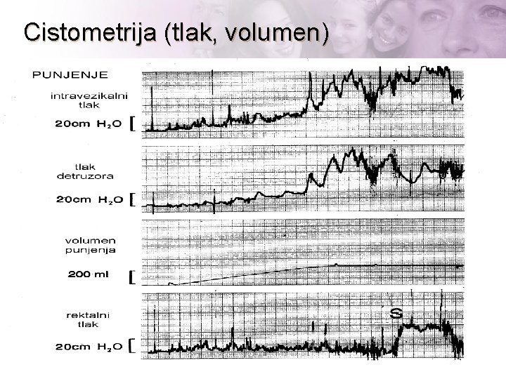 Cistometrija (tlak, volumen) 