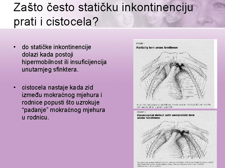 Zašto često statičku inkontinenciju prati i cistocela? • do statičke inkontinencije dolazi kada postoji