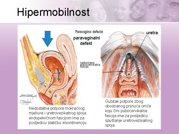 Hipermobilnost uretra paravaginalni defekt rupturirana pubocervikalna fascija Nedostatna potpora mokraćnog mjehura i uretrovezikalnog spoja