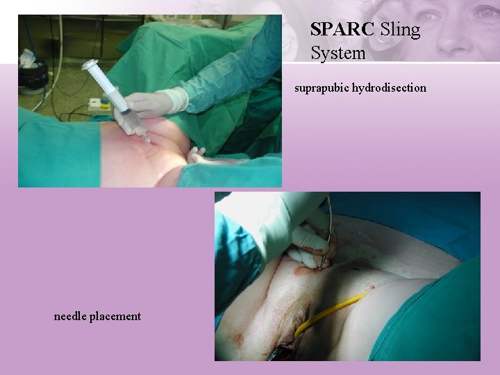 SPARC Sling System suprapubic hydrodisection needle placement 