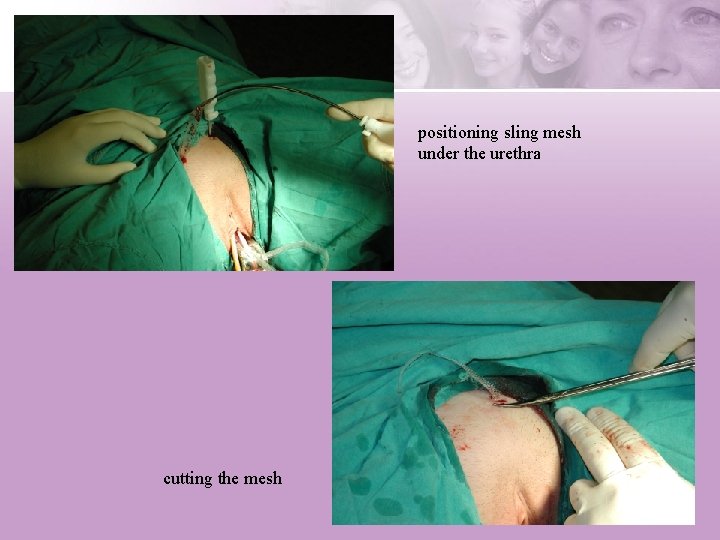 positioning sling mesh under the urethra cutting the mesh 