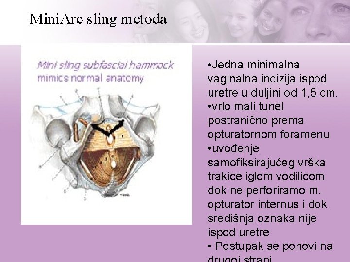 Mini. Arc sling metoda • Jedna minimalna vaginalna incizija ispod uretre u duljini od