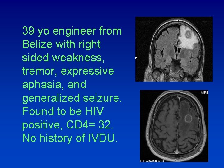 39 yo engineer from Belize with right sided weakness, tremor, expressive aphasia, and generalized