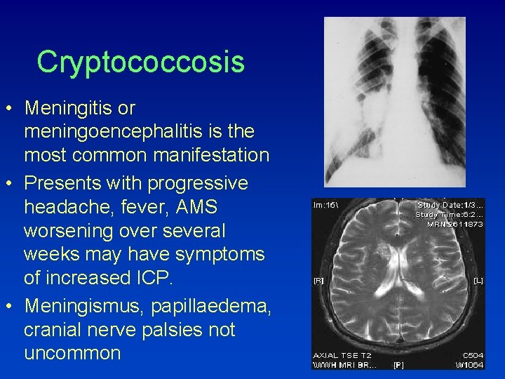 Cryptococcosis • Meningitis or meningoencephalitis is the most common manifestation • Presents with progressive