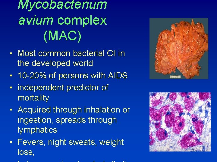 Mycobacterium avium complex (MAC) • Most common bacterial OI in the developed world •