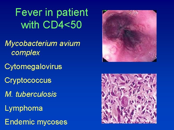 Fever in patient with CD 4<50 Mycobacterium avium complex Cytomegalovirus Cryptococcus M. tuberculosis Lymphoma