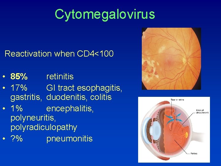 Cytomegalovirus Reactivation when CD 4<100 • 85% retinitis • 17% GI tract esophagitis, gastritis,