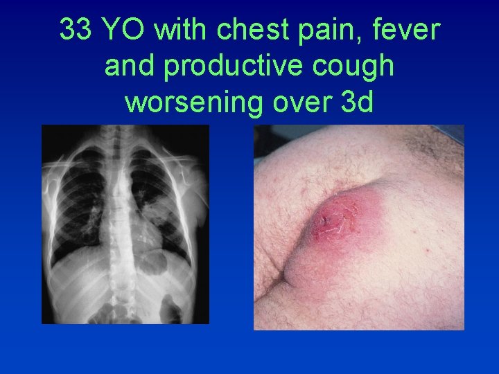 33 YO with chest pain, fever and productive cough worsening over 3 d 