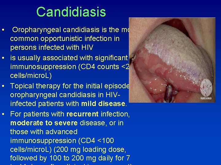 Candidiasis • Oropharyngeal candidiasis is the most common opportunistic infection in persons infected with