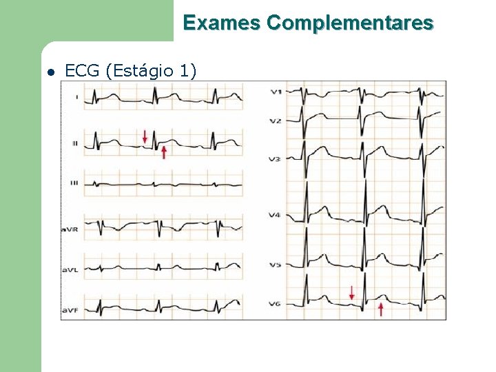 Exames Complementares l ECG (Estágio 1) 