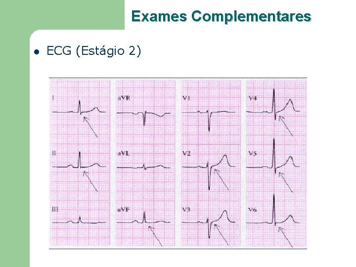 Exames Complementares l ECG (Estágio 2) 