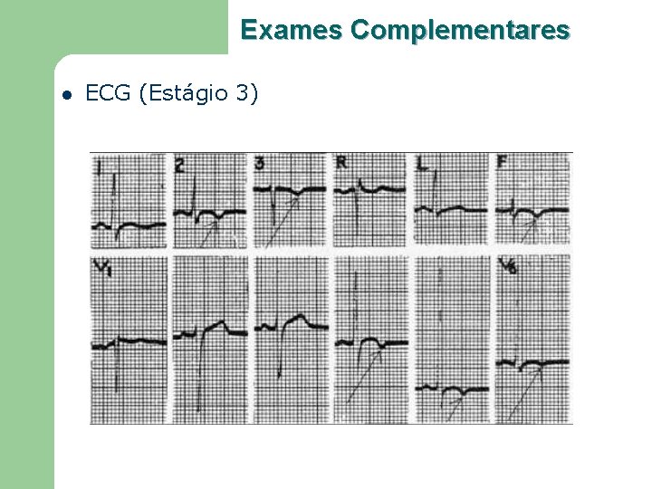 Exames Complementares l ECG (Estágio 3) 