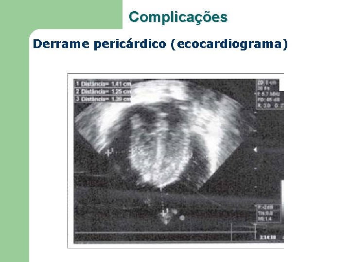 Complicações Derrame pericárdico (ecocardiograma) 