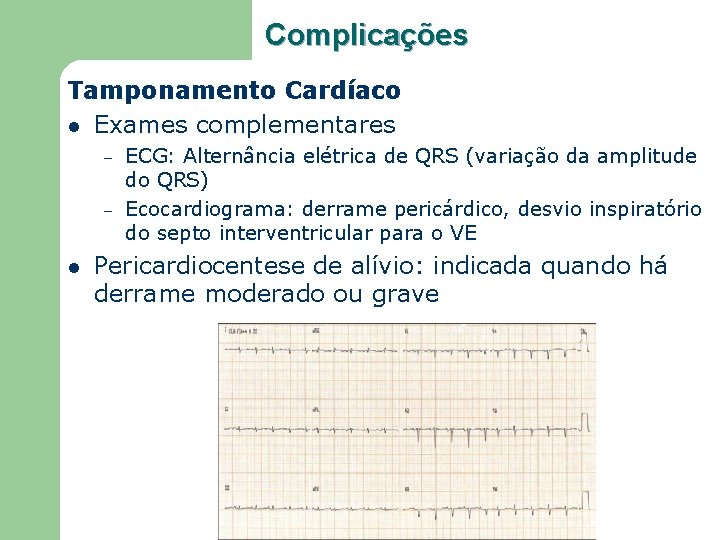 Complicações Tamponamento Cardíaco l Exames complementares – – l ECG: Alternância elétrica de QRS