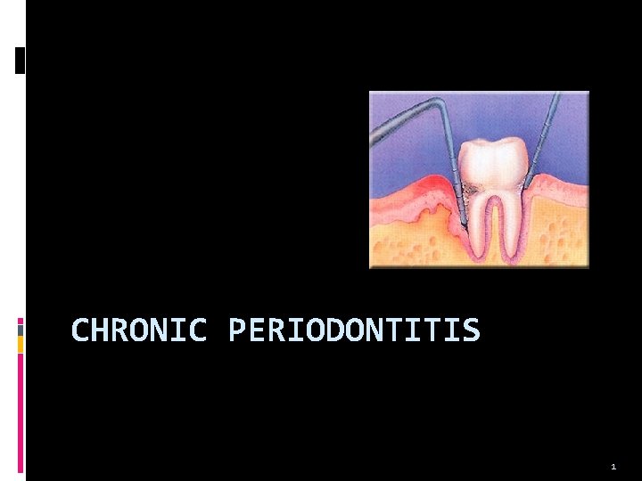 CHRONIC PERIODONTITIS 1 
