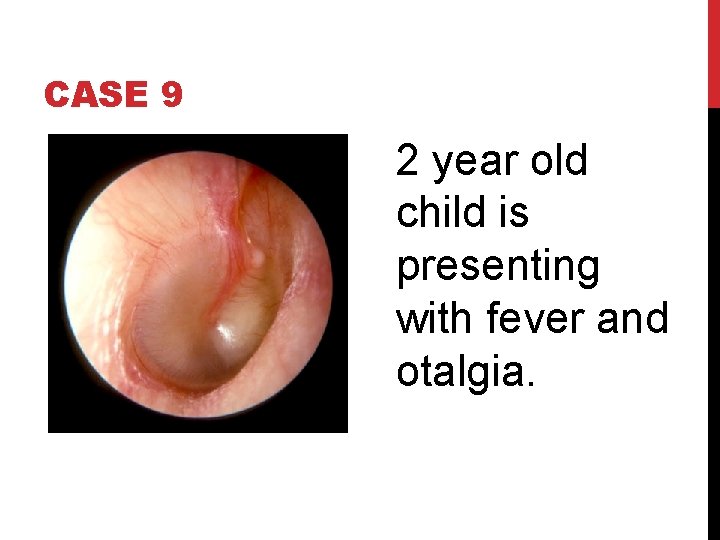 CASE 9 2 year old child is presenting with fever and otalgia. 