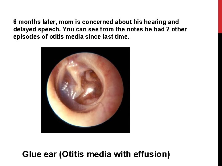 6 months later, mom is concerned about his hearing and delayed speech. You can