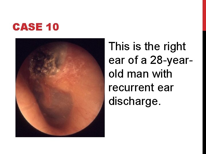 CASE 10 This is the right ear of a 28 -yearold man with recurrent