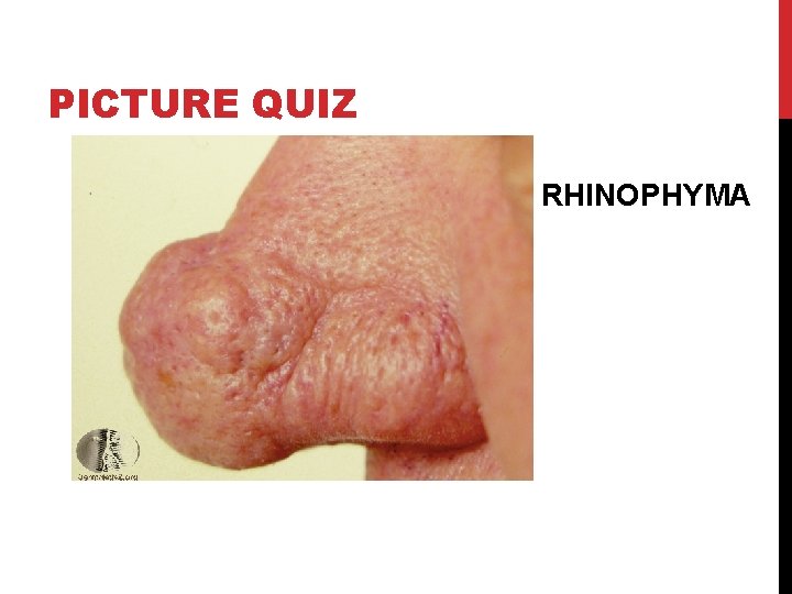 PICTURE QUIZ RHINOPHYMA 