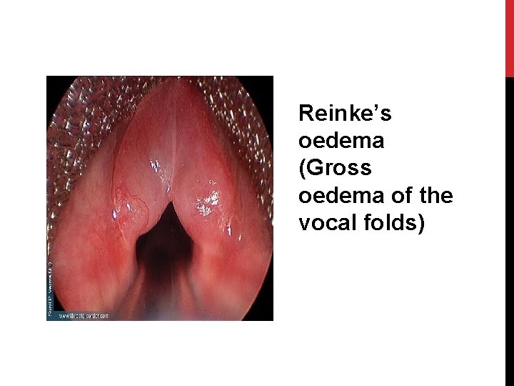 Reinke’s oedema (Gross oedema of the vocal folds) 