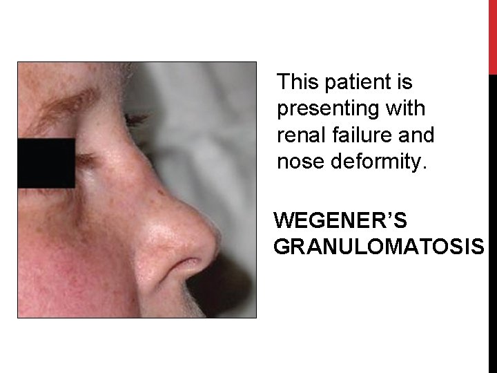 This patient is presenting with renal failure and nose deformity. WEGENER’S GRANULOMATOSIS 