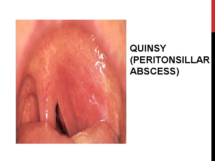 QUINSY (PERITONSILLAR ABSCESS) 