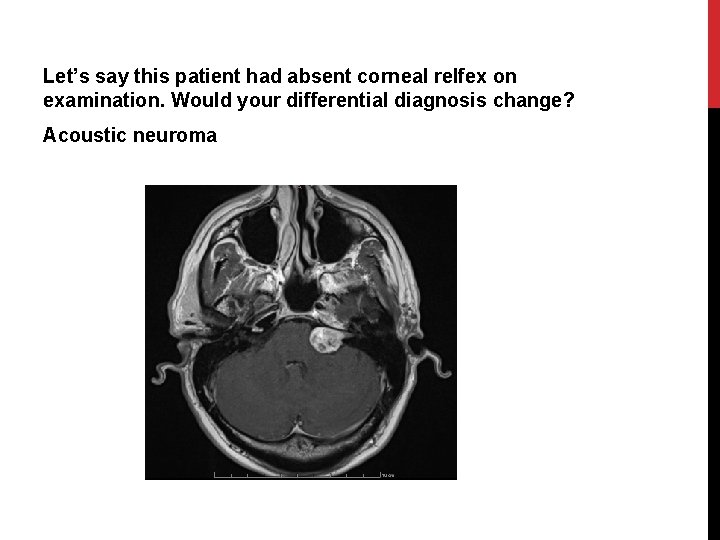 Let’s say this patient had absent corneal relfex on examination. Would your differential diagnosis