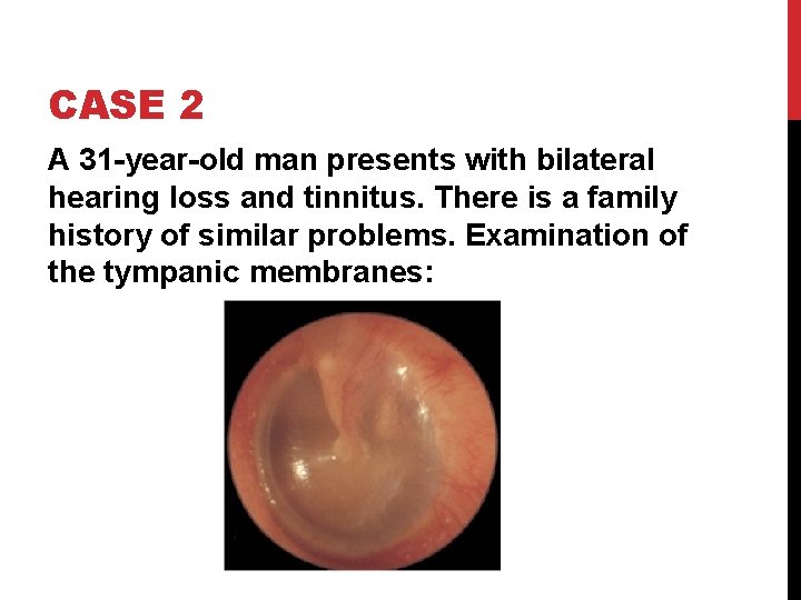 CASE 2 A 31 -year-old man presents with bilateral hearing loss and tinnitus. There