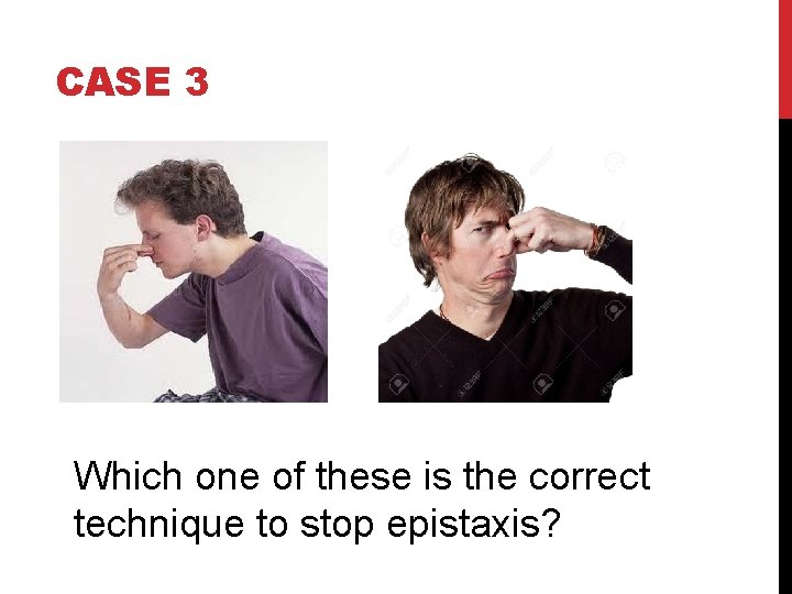 CASE 3 Which one of these is the correct technique to stop epistaxis? 