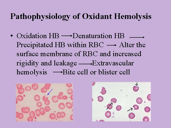 Pathophysiology of Oxidant Hemolysis • Oxidation HB Denaturation HB Precipitated HB within RBC Alter