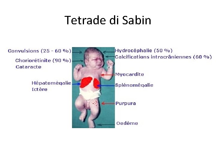 Tetrade di Sabin 