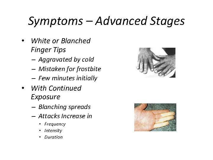 Symptoms – Advanced Stages • White or Blanched Finger Tips – Aggravated by cold