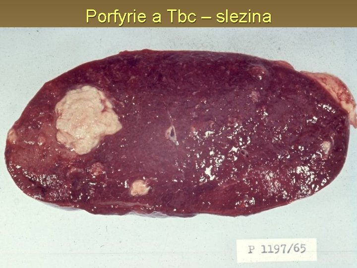 Porfyrie a Tbc – slezina 