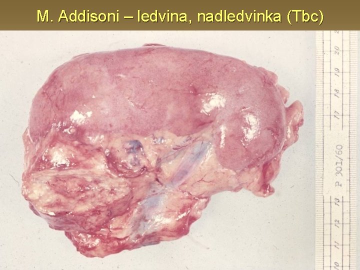 M. Addisoni – ledvina, nadledvinka (Tbc) 