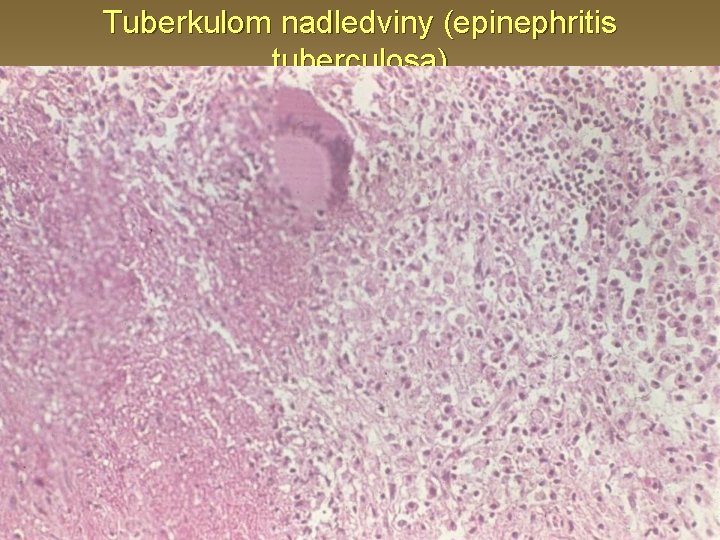 Tuberkulom nadledviny (epinephritis tuberculosa) 